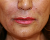 Feel Beautiful - Hyaluronan gel (Juvederm) around lips - After Photo